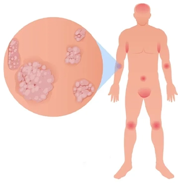 Genital Siğil Tedavisi